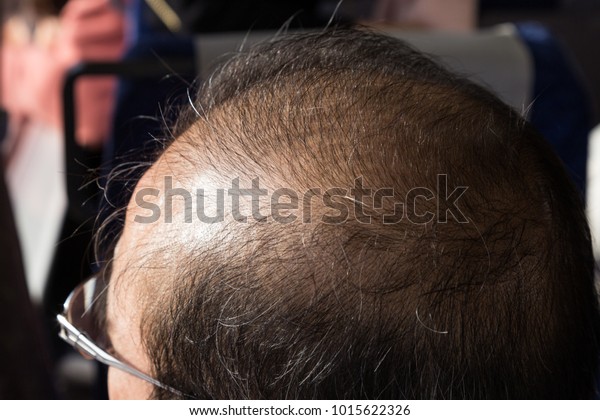 Closeup Balding Thinning Hair Man Crown Stock Photo Edit Now