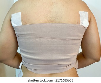 Close-up Of A Bandage Girl After Undergoing Breast Removal Surgery (bilateral Mastectomy Operation)