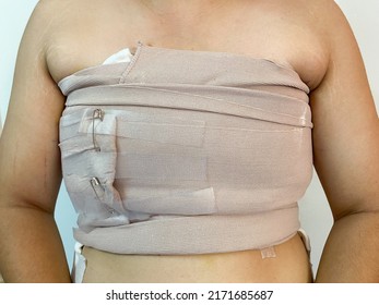 Close-up Of A Bandage Girl After Undergoing Breast Removal Surgery (bilateral Mastectomy Operation)