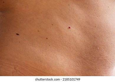 Close-up Of Bare Skin On Back With Red And Brown Moles And Age Spots. Checking For Benign Moles. Effect Of Sun On Skin. Moles On Skin