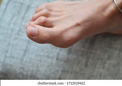 Closeup of barefeet woman with  Medical condition called bunions or hammer toes  feet problem.