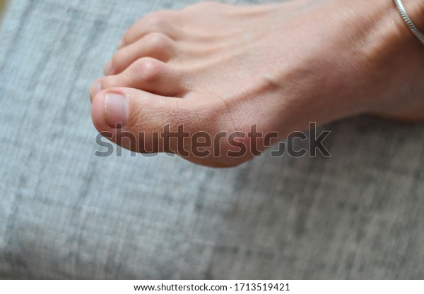 Closeup of barefeet woman with \
Medical condition called bunions or hammer toes  feet\
problem.