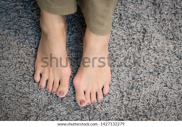 Closeup of barefeet woman with painful toes - \
Medical condition called bunions or hammer toes (Hallux valgus)\
painful and suffering. Middle aged woman\'s health concept - feet\
problem.