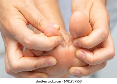 Closeup of barefoot of girl suffering with athlete's foot due to