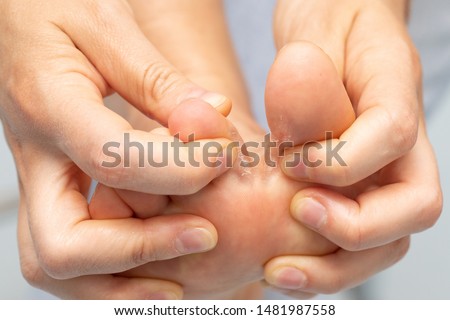 Closeup of barefoot of girl suffering with athlete's foot due to