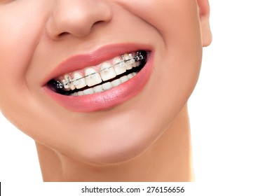 Closeup Beautiful Female Smile With Transparent Ceramic And Metal Braces On Teeth. Orthodontic Treatment.