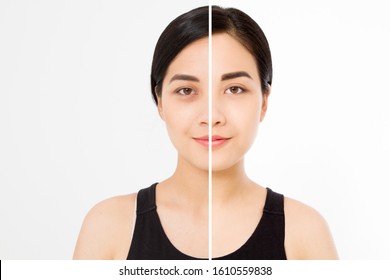 Closeup Before After Asian Woman Face. Before-after Cosmetic Procedures. Skin Care Wrinkled Face, Dark Circles Under Eyes. Before-after Anti-aging Facelift Treatment. Facial Skincare Beauty Contouring