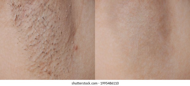 Close-up before and after skincare cosmetology armpits epilation treatment concept. Problem underarm chicken skin, Fox Fordyce, black armpit in woman texture background . 