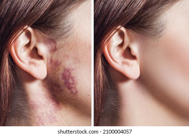 Closeup Of Before And After Treatment Woman Face With Real Port Wine Stain Or Birthmark On Face. Therapy And Skin Laser Healing. Healthcare And Facial Care Concept.