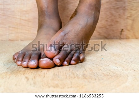 Closeup of black African woman bare foot suffering from painful toes. Removed her  stilettos in discomfort at work, shoe store or home for High heels shoe feet pain and foot problem concept