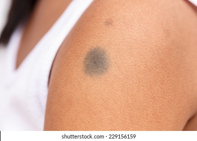 Close-up Of Black Birthmark On Skin