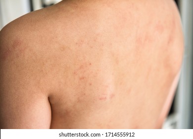 Closeup Boy Back With Eczema Atopic Dermatitis Skin. Cow's Milk Protein Allergy Caused Rash In Children. Healthy Kid Or Baby Insurance And Child Disease Concept.