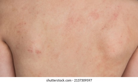 Closeup boy back with Eczema atopic dermatitis skin. Cow milk protein allergy caused rash in children. Healthy insurance and child disease concept