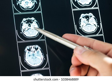 Closeup Of Brain MRI Scan Result