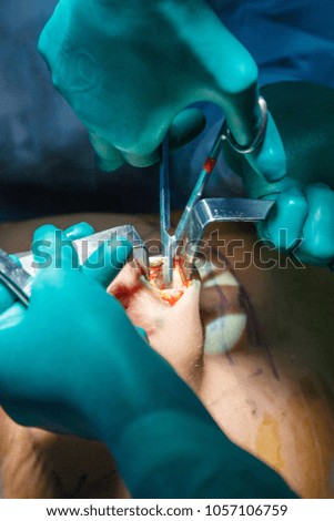 Close-up breast augmentation surgery in the operating room surgeon tools implant