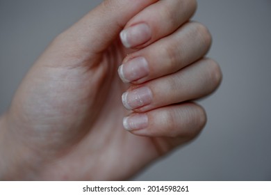 Close-up Of Brittle Nails. Damage To The Nail After Using Shellac Or Gel Polish. Peeling On The Nails. Shattered And Chipped Nails. Nails And Cuticle Problems. Hands Care Concept. Ugly Manicure.