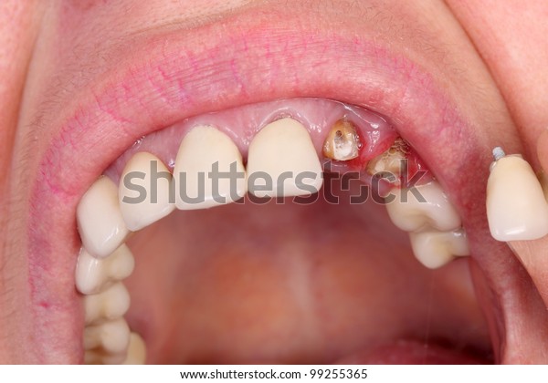 Closeup Broken Artificial Tooth Inflammation Gingivitis Stock Photo ...