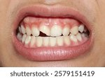 Close-up of a broken tooth with visible cracks and damage. The fractured enamel and dentin expose the tooth’s inner layers, highlighting dental injury and oral health concerns.