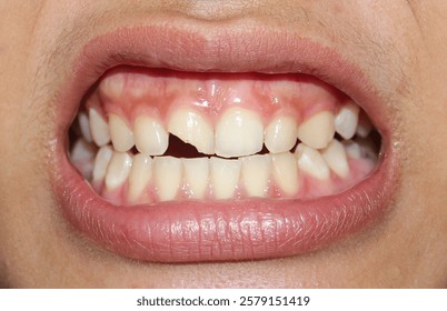 Close-up of a broken tooth with visible cracks and damage. The fractured enamel and dentin expose the tooth’s inner layers, highlighting dental injury and oral health concerns.