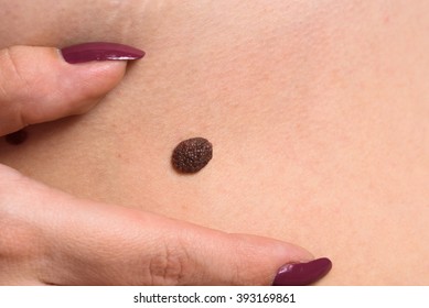 Close-up Of Brown Birthmark (nevus) 