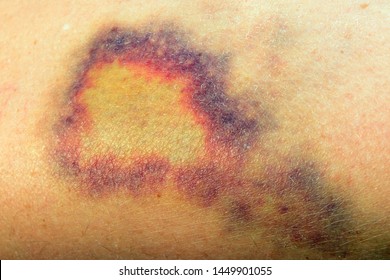 Bruise Color Chart