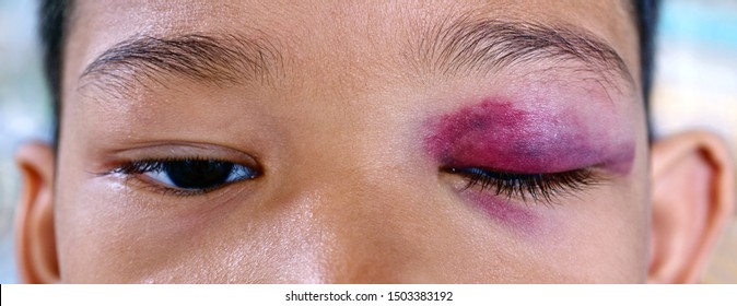 Black Eye Bruise Images, Stock Photos & Vectors | Shutterstock