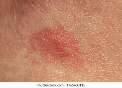 Closeup Bug Bite On Human Skin Stock Photo 1765408115 | Shutterstock