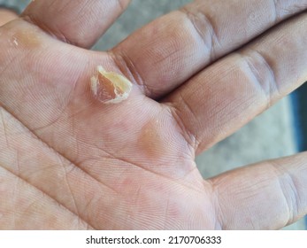 Closeup of calloused hands. scalded skin due to heavy lifting