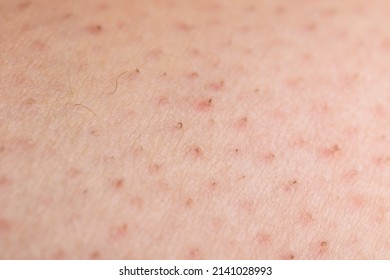 Closeup of caucasian skin with ingrown hairs on the leg. Irritated human skin due to epilation. Selective focus 