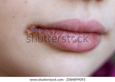 Close-up of chapped lips with angular cheilitis.