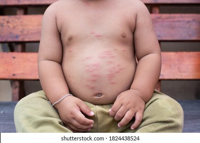 Closeup Of Child Skin Itching Rash