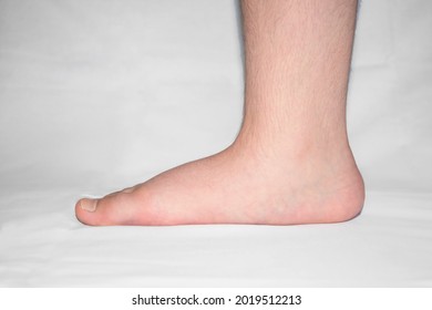 Close-up Of A Child's Bare Foot With A Strong Flat Foot, Also Called Pes Planus Or Fallen Arches.