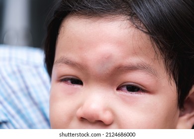 Closeup Of Child's Forehead Showing Signs Of Injury From Head Impact With Solid Object. Baby Boy Cried Out Of Pain. Kid Aged 3 Years Old.