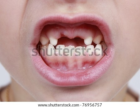 Closeup of child's month with missing teeth