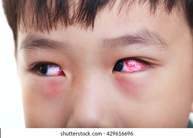 Closeup Of Chronic Conjunctivitis With A Red Iris. Shallow Depth Of Field (dof), Left Eye Of Asian Child In Focus. Studio Shot.