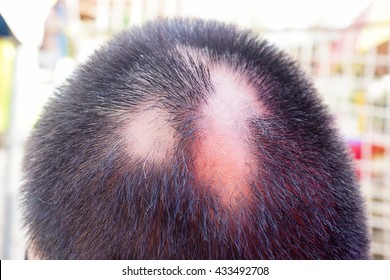 薄毛 後頭部 の写真素材 画像 写真 Shutterstock 薄毛 後頭部 の写真素材 画像 写真 Shutterstock