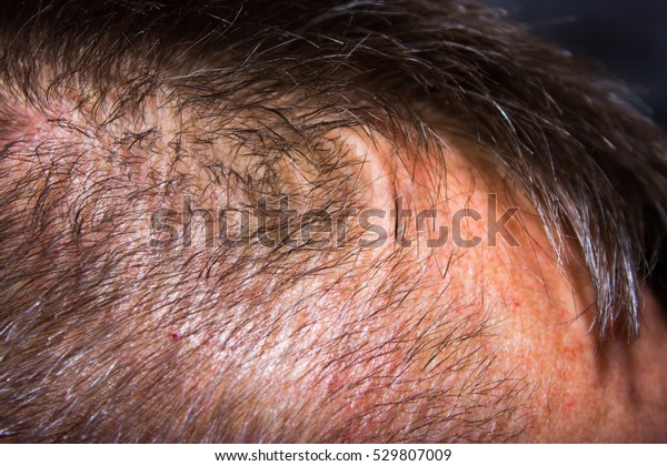 Closeup Circular Hair Loss Back Head Stock Photo (Edit Now) 529807009