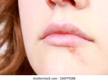 Closeup Of A Common Cold Sore Virus Herpes.