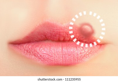 Closeup Of A Common Cold Sore Virus Herpes.