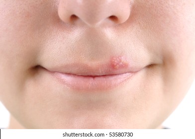 Closeup Of A  Common Cold Sore Virus Herpes.