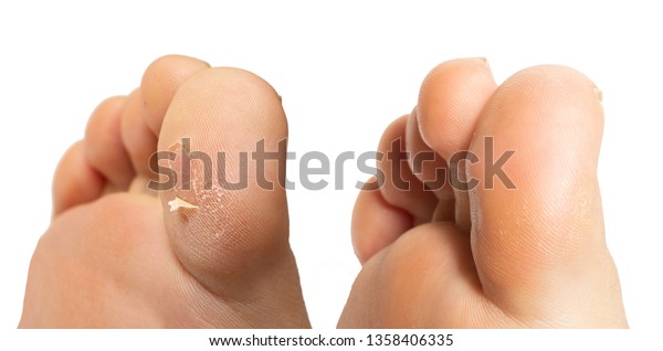 2フィートの接写 足は足の親指にたこ状の皮膚が付いていて 足は付いていない の写真素材 今すぐ編集