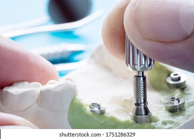 Closeup/ Convertible abutment components/ Dental implant temporary abutment/ Abutment screw implant. - Shutterstock ID 1751286329