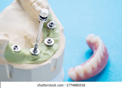 Closeup/ Convertible abutment components/ Dental implant temporary abutment/ Abutment screw implant. - Shutterstock ID 1774880318