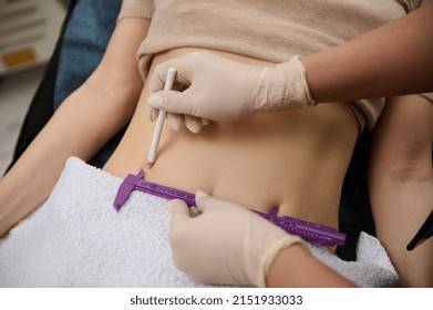 Close-up cosmetologist doctor measures the level of belly fat with caliper and draws lines with white pencil on the abdomen of a woman lying on a daybed in a spa clinic before hardware liposuction