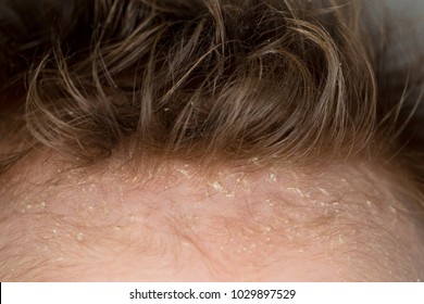 Closeup Of Cradle Cap Of A Newborn Baby On His Scalp