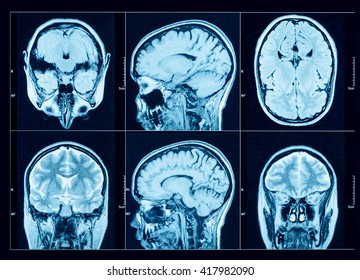 Closeup Of A CT Scan With Brain