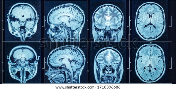 Closeup of a CT\
scan with brain. Medical, science and education mri brain\
background. Magnetic resonance\
imaging.
