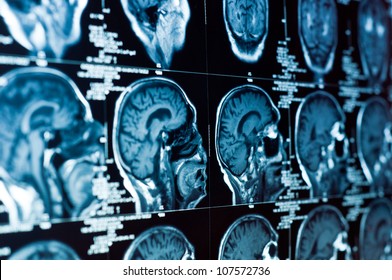 Closeup Of A CT Scan With Brain And Skull On It