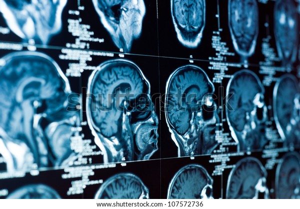 Closeup of a CT\
scan with brain and skull on\
it