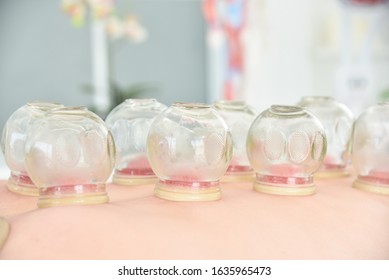 Closeup Cupping Treatment On Patient Back Stock Photo (Edit Now) 1513574558